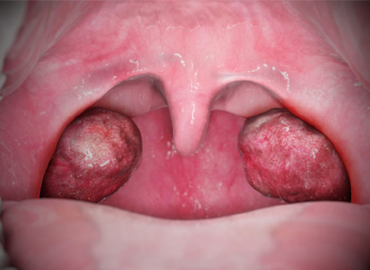 ayurvedic_treatment_for_tonsils.jpg